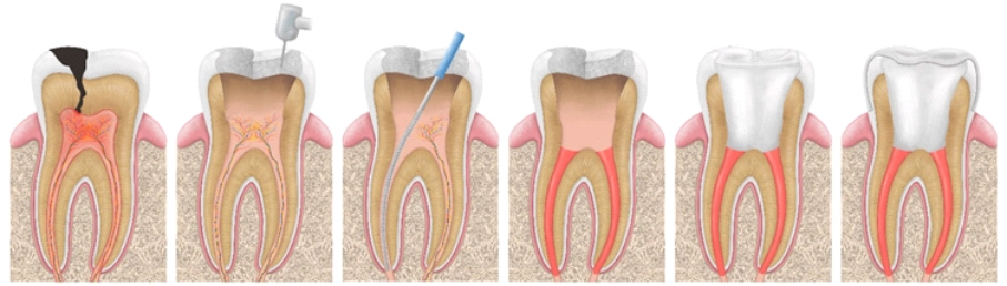 Root Canal